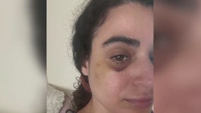 Fairfax woman says homeless man attacked her unprovoked while she was walking dog